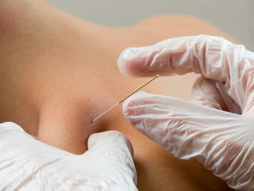 Acupuncture and Dry Needling